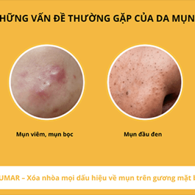 Top 5 kem trị thâm mụn hiệu quả nhất hiện nay